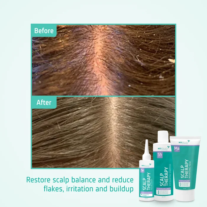 Scalp Therapy Healthy scalp routine before after