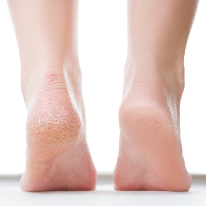 i-Spa Heel Peel Online Course