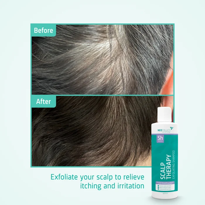 Scalp Therapy Exfoliating Shampoo before after