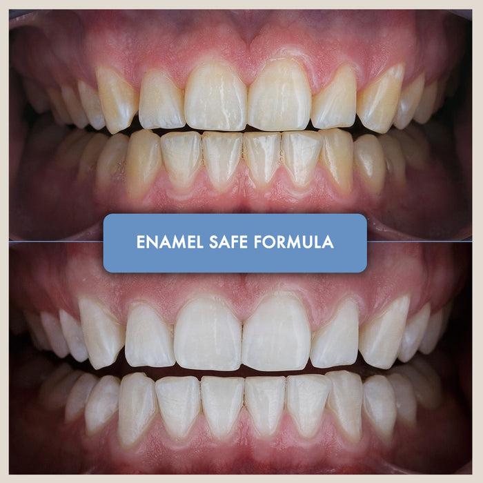 Teeth Whitening Kit