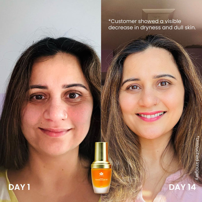 Before and after comparison of a woman’s face showing improvement in skin hydration and brightness after 14 days using Timeless Kumkumadi Oil | Shankara, with visible reduction in dryness and dullness.